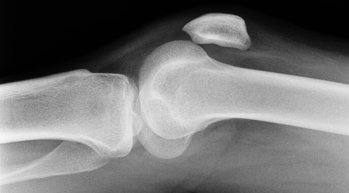 knee patellar dislocation x ray